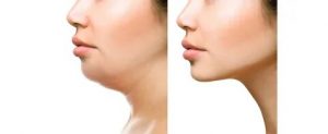 coolsculpting vs kybella