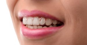 Clear Invisible Braces