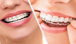 Invisalign braces