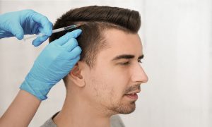 Hair Transplantation
