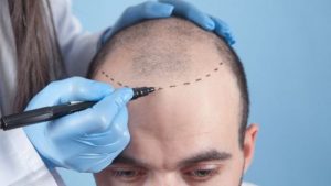 FUE hair transplant