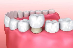 How Long Do Temporary Crowns Last On Front Teeth